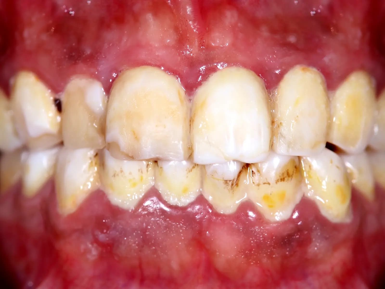 Veneers & crowns — Before