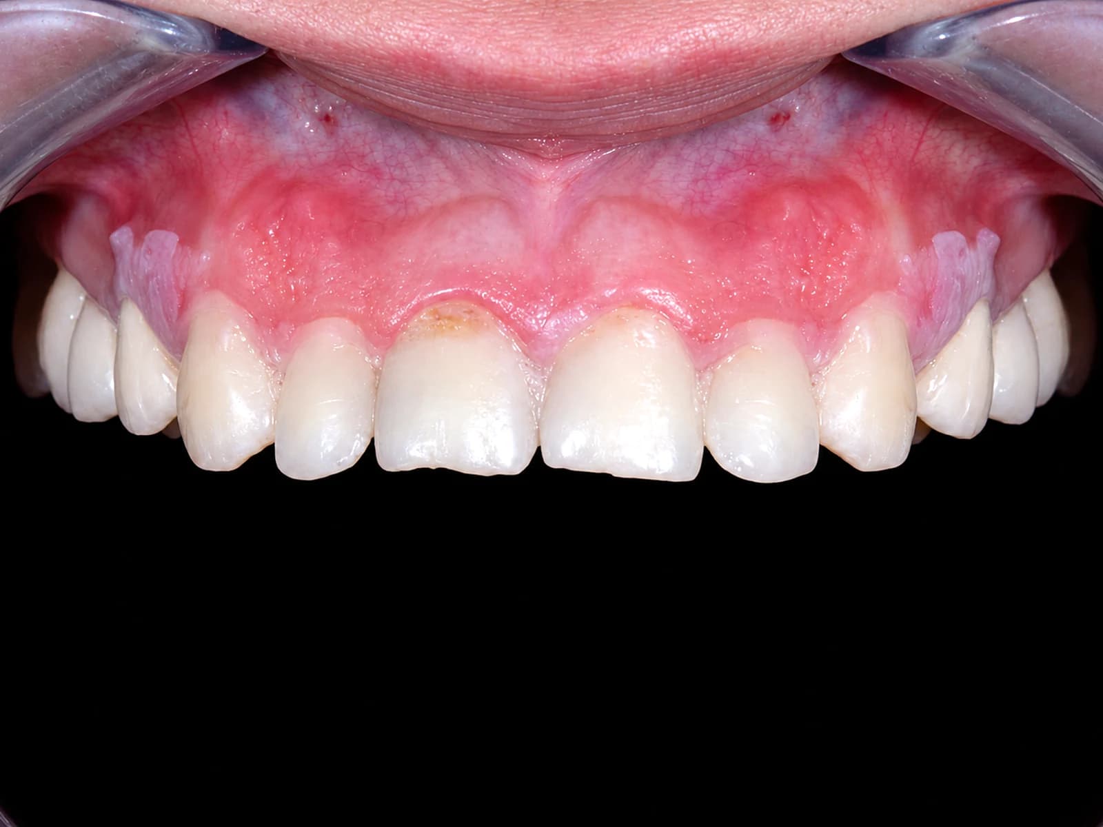 Full crowns — Before