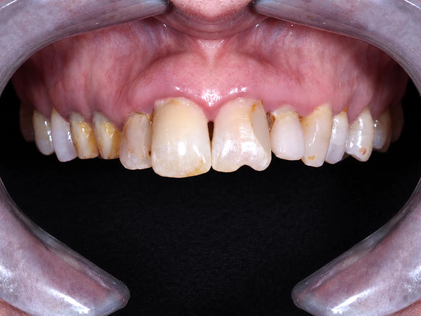 Veneers & crowns — Before